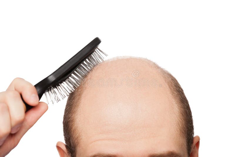 Umana alopecia o perdita di capelli, adulto, man mano che tiene pettine sulla testa calva.
