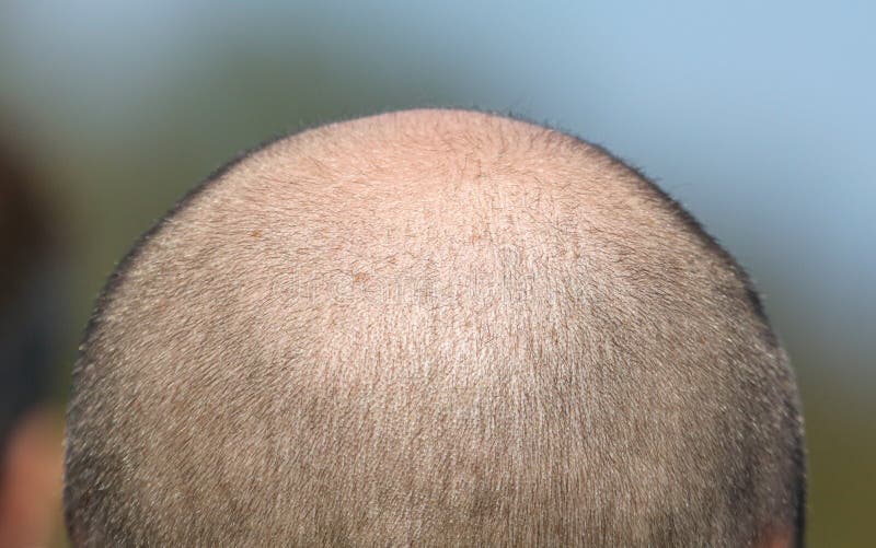 Bald Patch on the Head of a Man. Stock Image Image of male, care