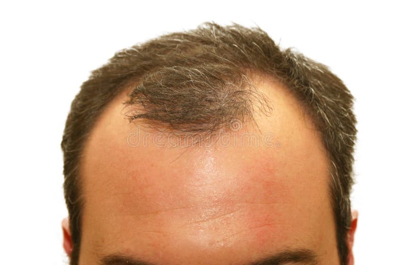 Balding head stock image. Image of improvement, forehead - 5300257