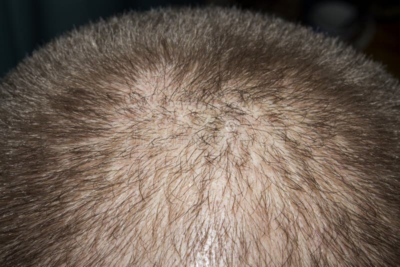 The balding man s head