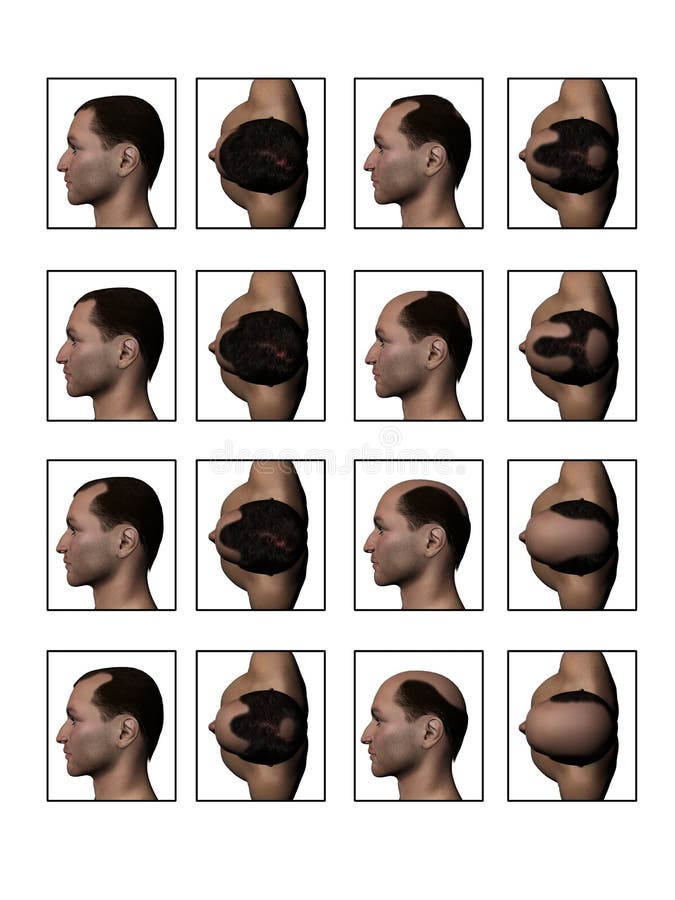 What are Hairlines? Different Types of Hairlines for Female and Men