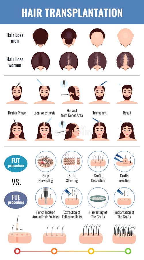 Update more than 146 hair fall after hair transplant latest