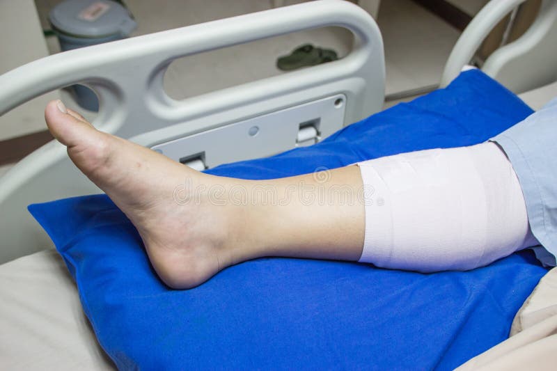 Bandaged Leg on a Hospital Bed. Stock Photo Image of broken, health