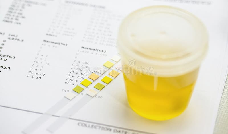 Bande De Réactif Utilisée Pour L'analyse D'urine Avec Un Flacon De Type D'urine  Collecté Comme éléments De Sédiments Anormaux Image stock - Image du  bandes, contrôle: 246392459