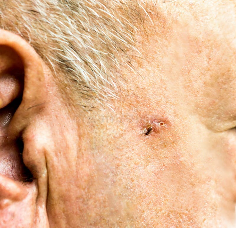 Basal Cell Carcinoma on the face of older man stock photos Basal Cell Carcinoma on the face of older man stock photos