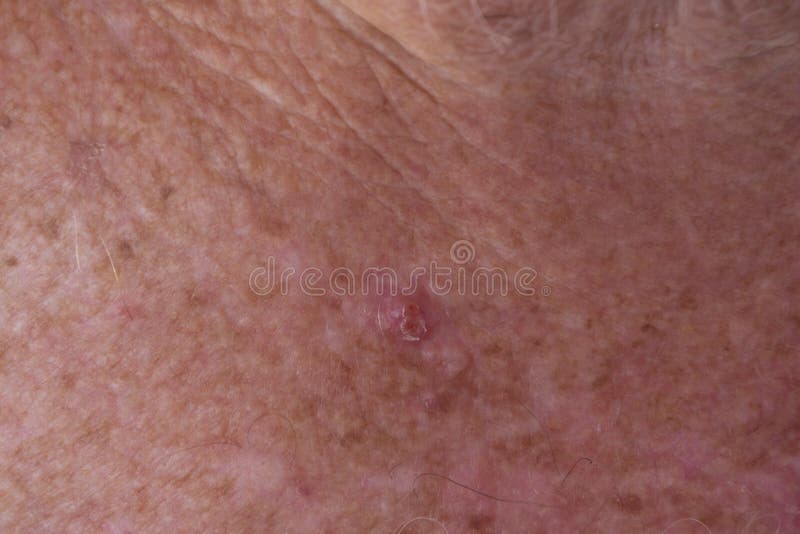 Skin Cancer Rash On Chest