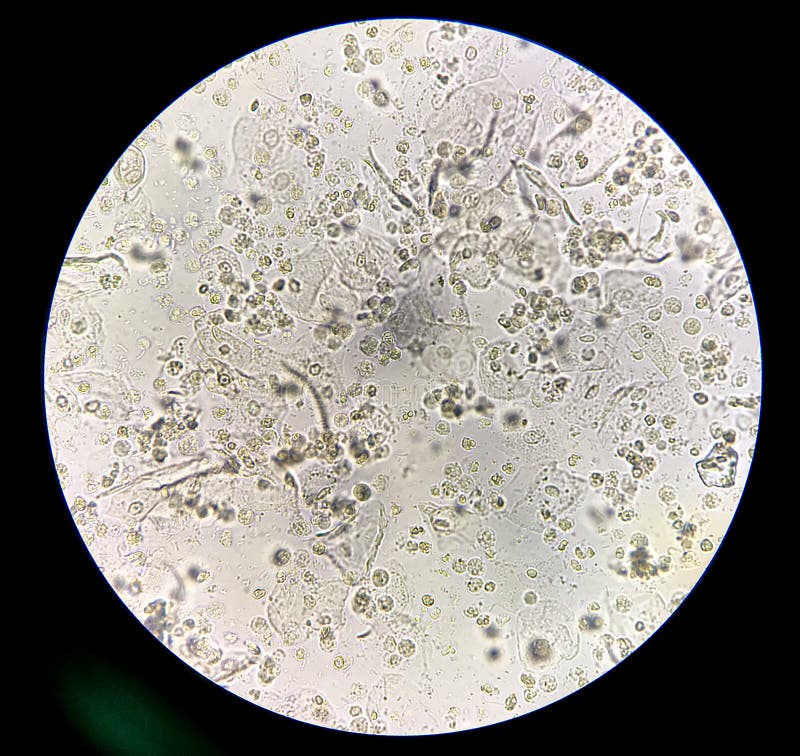 batteri moderati e globuli bianchi nell'infezione del tratto urinario del batterio