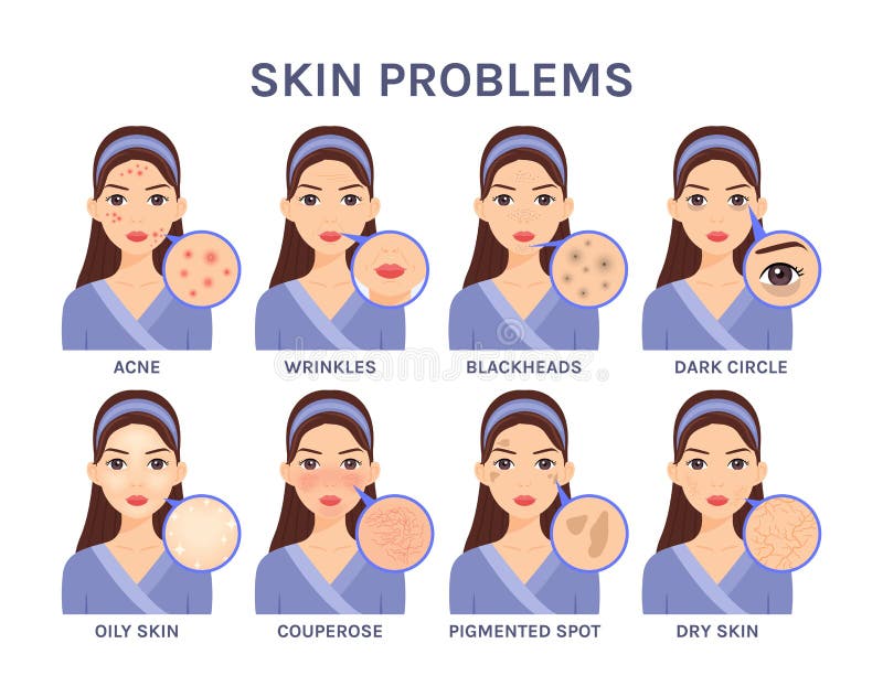 Beautiful cartoon Woman and Skin Problems.Portrait of a Girl and close-up of facial Diseases: Acne, Blackheads, Wrinkles, Dark