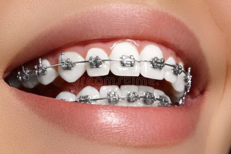 Beautiful white teeth with braces. Dental care photo. Woman smile with ortodontic accessories. Orthodontics treatment