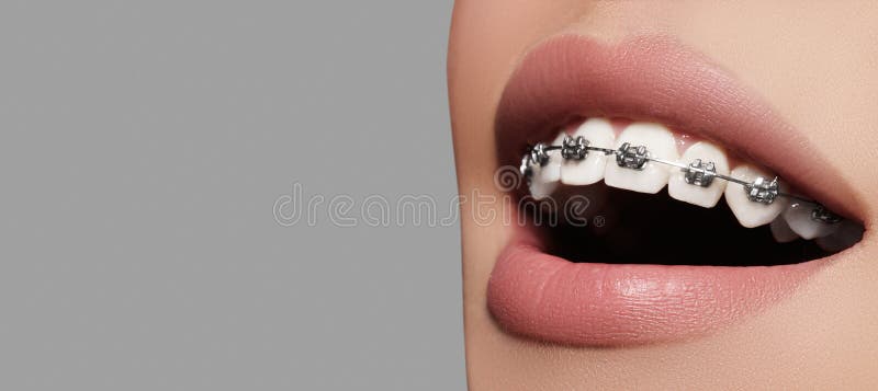 Orthodontist braces uv light hi-res stock photography and images