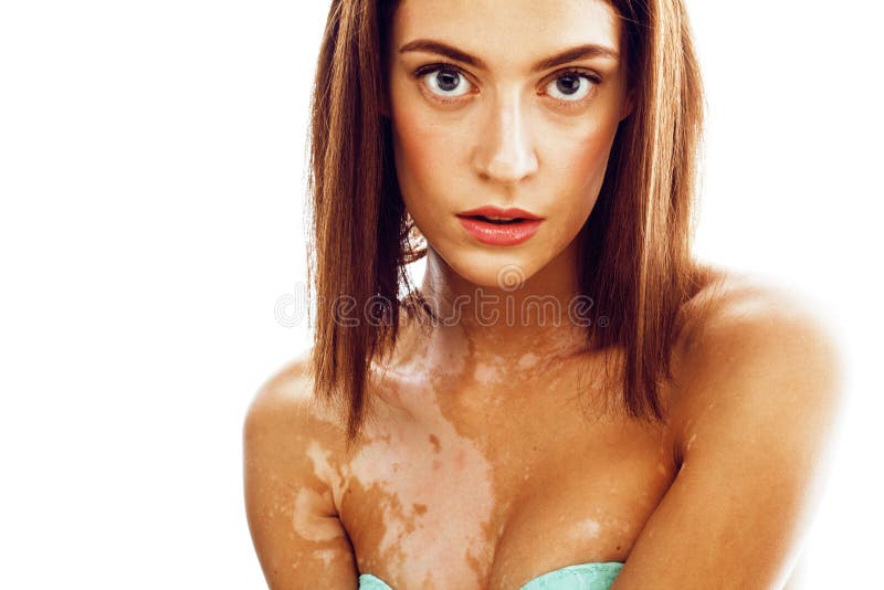 Beautiful young brunette woman with vitiligo disease close up isolated on white positive smiling, model problems concept