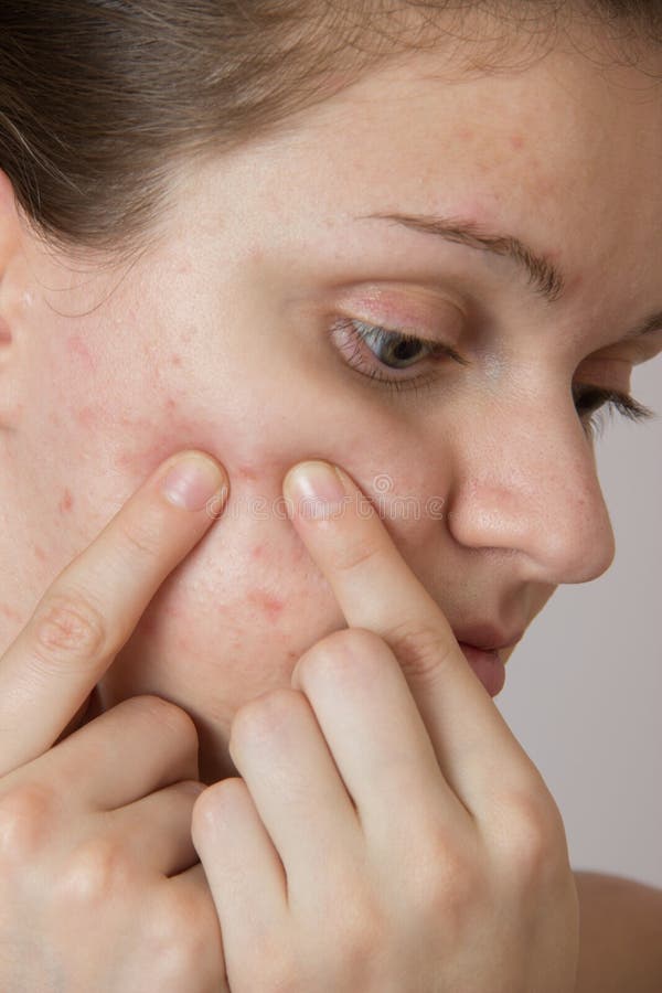 Beautiful young girl with acne on his face and the back on a white background stock images Beautiful young girl with acne on his face and the back on a white background stock images