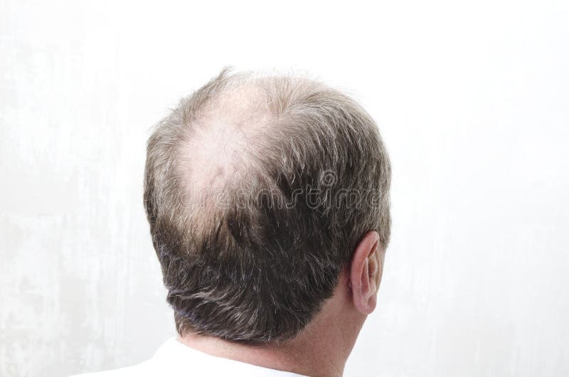 Bald Back of Men`s  of Baldness Stock Photo - Image of loss,  hand: 144488974