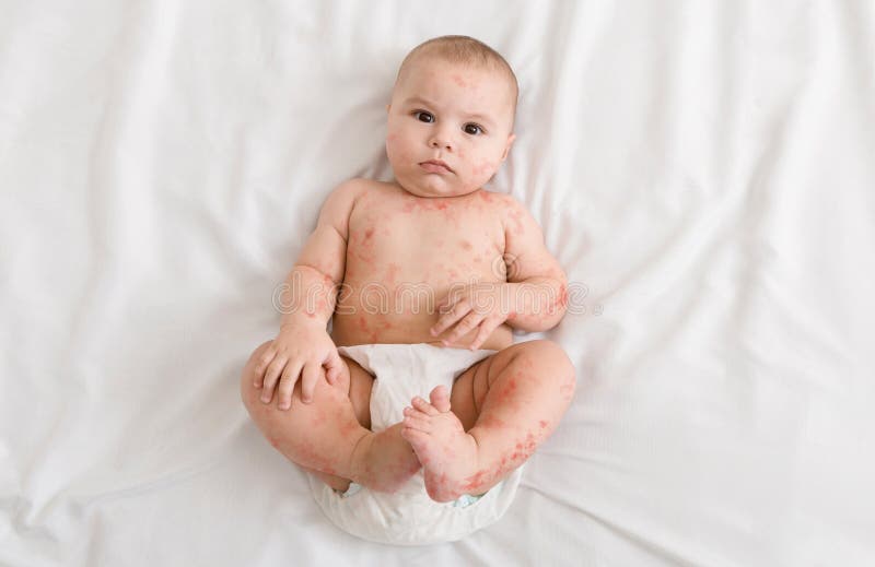 Measles. Upset newborn baby suffering from viral disease rash, lying on bed, top view. Measles. Upset newborn baby suffering from viral disease rash, lying on bed, top view