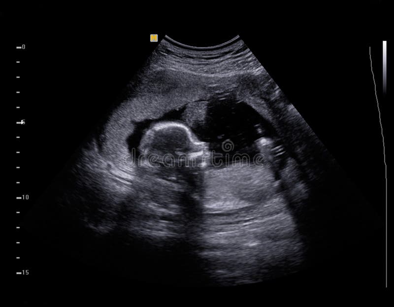 Bebê do ultrassom