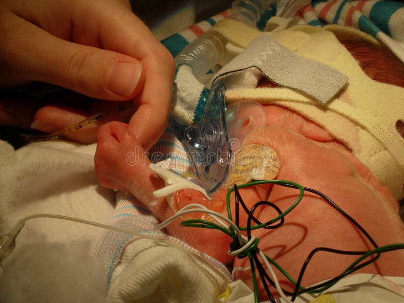 Bebê prematuro com a máscara de CPAP que guarda o dedo
