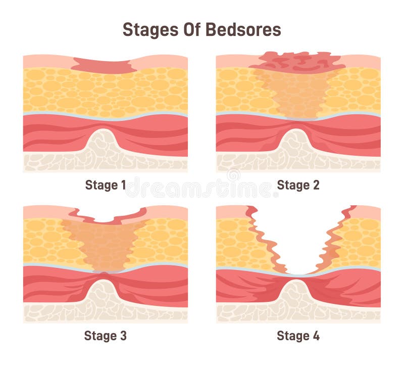 pressure-ulcer-bed-stock-illustrations-17-pressure-ulcer-bed-stock