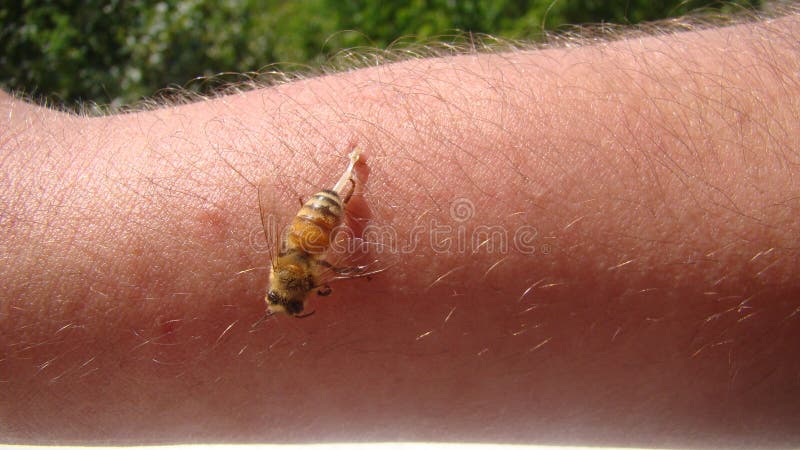 Bee: Apis Mellifera. Treatment by Honey Bee Sting. Closeup Honey Bee Stinging a Hand. Close Up Bee Worker. Insects, Insect, Animal Stock Image - Image of anim, gardennbeauty: 198459517 Bee: Apis Mellifera. Treatment by Honey Bee Sting. Closeup Honey Bee Stinging a Hand. Close Up Bee Worker. Insects, Insect, Animal Stock Image - Image of anim, gardennbeauty: 198459517