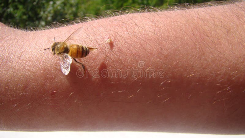 Bee : apis mellifera. treatment by honey bee sting. closeup honey bee stinging a hand. close up bee worker. insects, insect, anima