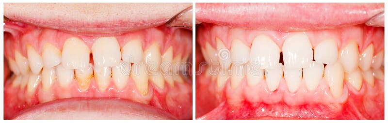 Teeth before and after tooth whitening treatment. Teeth before and after tooth whitening treatment.