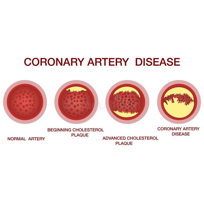 Begrip coronaire vaatziekte. gezonde en vernauwde slagaders met plaques