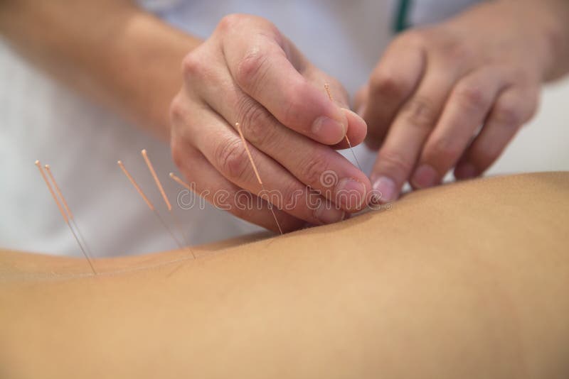 Behandeling door acupunctuur stock afbeelding Behandeling door acupunctuur stock afbeelding