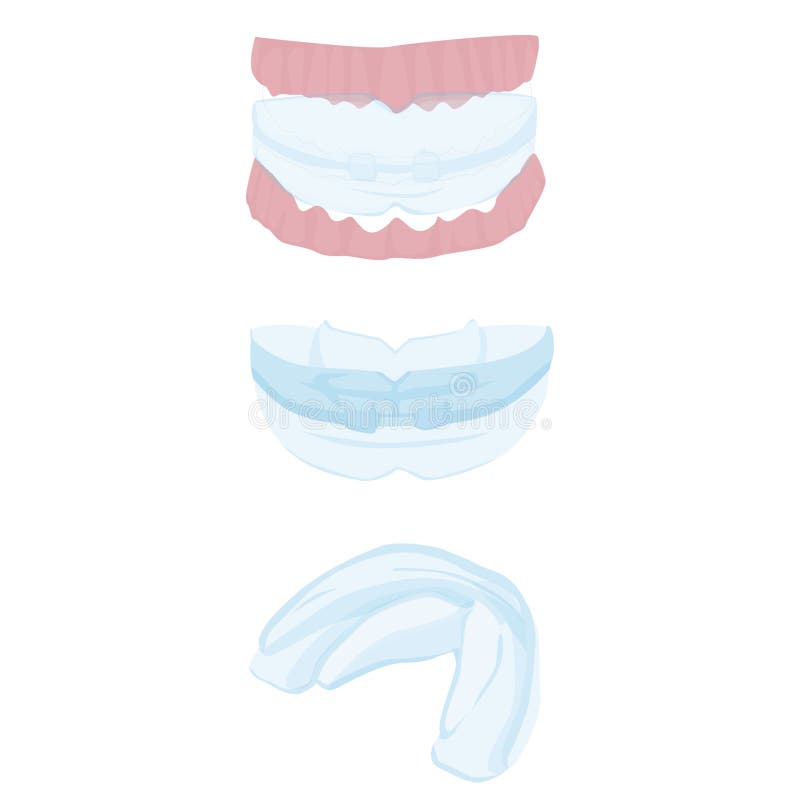 Retainer for teeth at different angles isolated on white background. mouthguard on the teeth. orthodontic retainer on the human jaw. teeth straightening tools. dentistry. vector flat. Retainer for teeth at different angles isolated on white background. mouthguard on the teeth. orthodontic retainer on the human jaw. teeth straightening tools. dentistry. vector flat