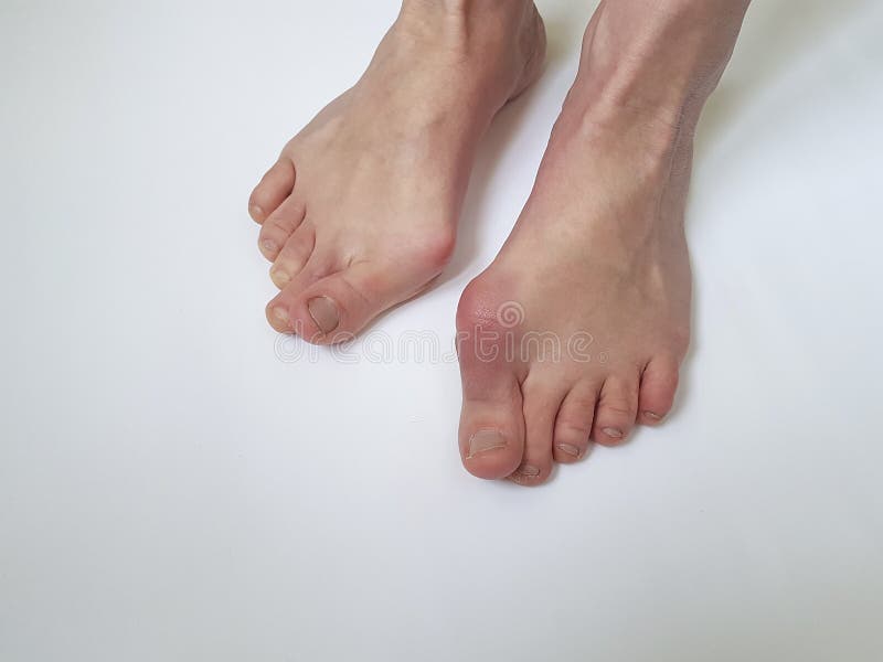 Bein-Problemmissbildung des Hallux valgus weibliche schmerzlich auf einem weißen Hintergrund lizenzfreie stockfotos Bein-Problemmissbildung des Hallux valgus weibliche schmerzlich auf einem weißen Hintergrund lizenzfreie stockfotos