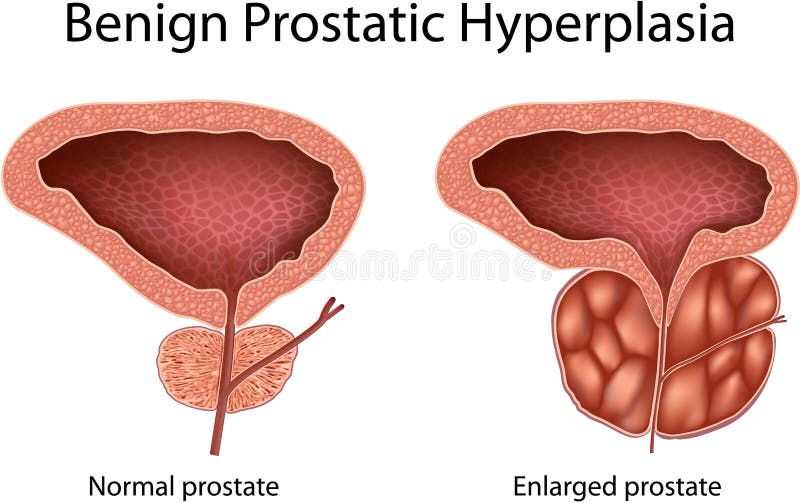 Vica fa és prostatitis