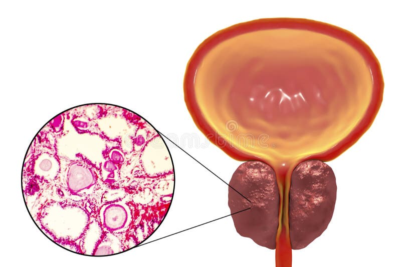 prostate adenoma