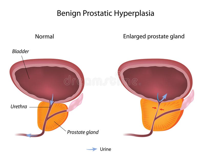 prostate equity hyperplasia)