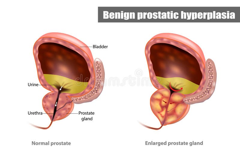 benign prostatic hyperplasia( bph))