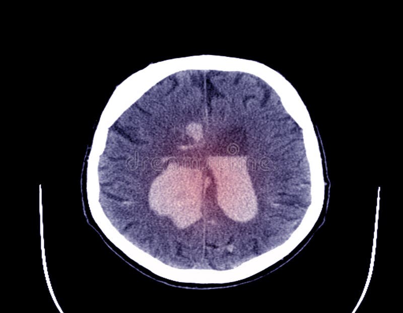 Beräknad tomography av hjärnan arkivfoton Beräknad tomography av hjärnan arkivfoton