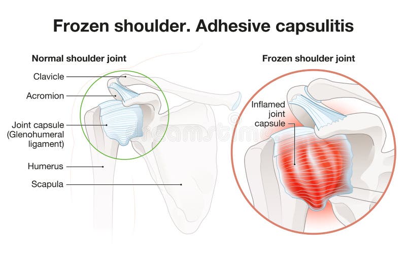 Bevroren schouder. adhesieve capsulitis chirurgie. gelabelde illustratie
