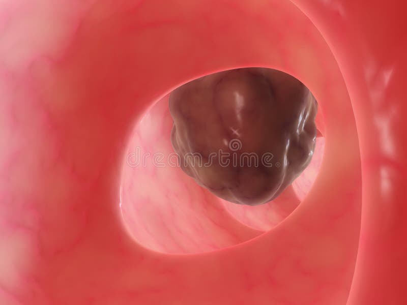 Big bowel polyp stock illustration. Illustration of cell 1619584