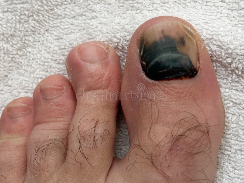 223 Broken Toenail Stock Photos - Free & Royalty-Free Stock Photos from Dreamstime 223 Broken Toenail Stock Photos - Free & Royalty-Free Stock Photos from Dreamstime