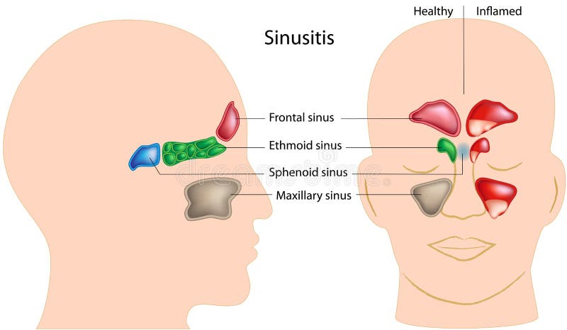 Diagram showing sinuses of the head, eps8, gradient and mesh printing compatible. Diagram showing sinuses of the head, eps8, gradient and mesh printing compatible