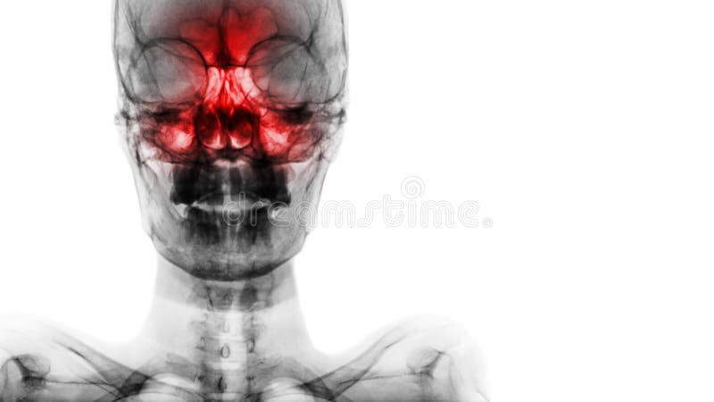 Bihåleinflammation på den frontal, ethmoid maxillary bihålan Filma röntgenstrålen av skallen och förbigå område på rätsidan arkivfoto Bihåleinflammation på den frontal, ethmoid maxillary bihålan Filma röntgenstrålen av skallen och förbigå område på rätsidan arkivfoto