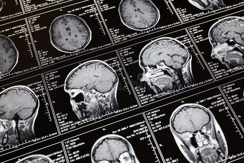 Bildläsning för magnetisk resonans av hjärnan MRI-huvudbildläsning arkivbild Bildläsning för magnetisk resonans av hjärnan MRI-huvudbildläsning arkivbild
