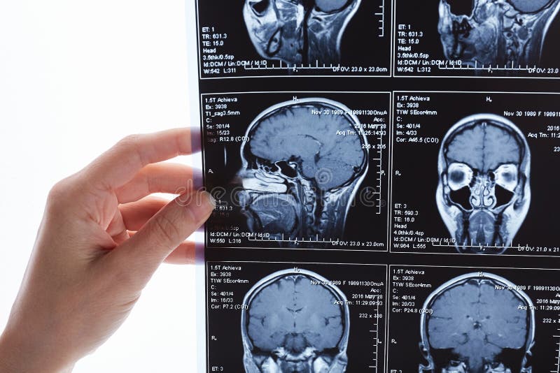 Bildläsning för magnetisk resonans av hjärnan MRI-huvudbildläsning arkivbilder Bildläsning för magnetisk resonans av hjärnan MRI-huvudbildläsning arkivbilder