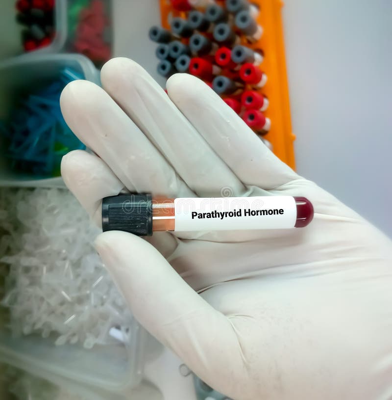 Biochemist Hold a Blood Sample for Parathyroid Hormone (PTH) Test Stock