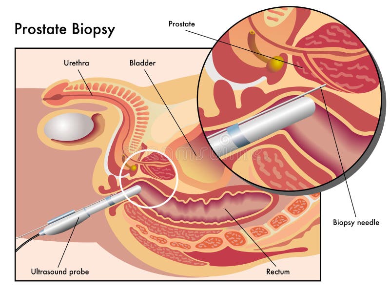 Biopsia de la próstata