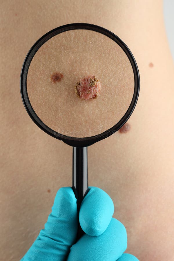 Birthmark. Dermatologist examines mole close up
