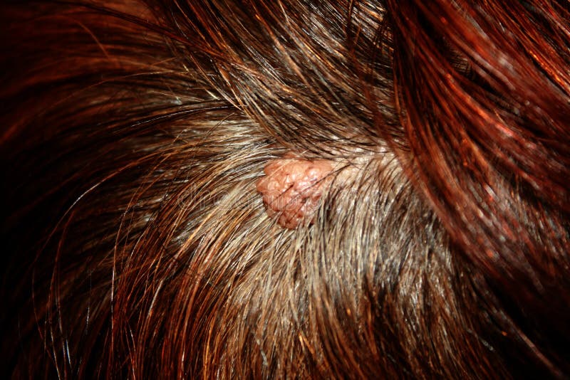 Nevus Hair Stock Photos Download 107 Royalty Free Photos