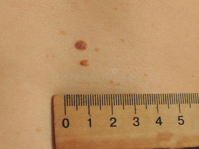 Keratoma Definition Stock Photos Free & RoyaltyFree Stock Photos