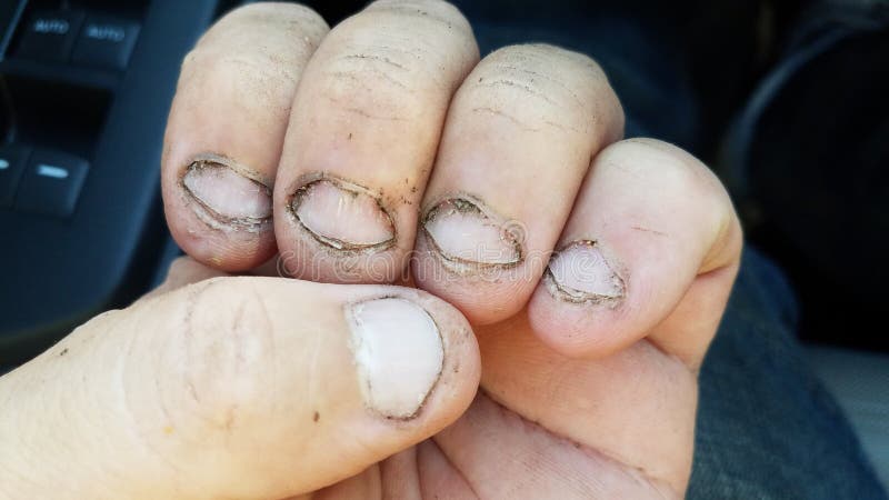 bitten-dirty-fingernails-hand-car-bitten-gross-dirty-fingernails-hand-car-194866053.jpg