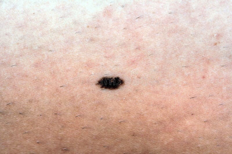 Black cancer of the skin is dangerous, hence, an investigation of birthmarks is important