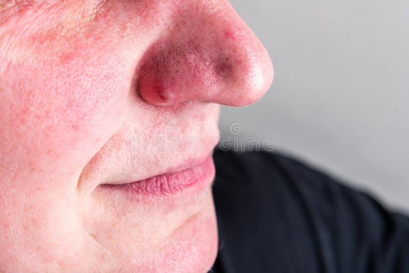 Black Dots And Acne On The Nose Stock Photo Image Of Girl Health
