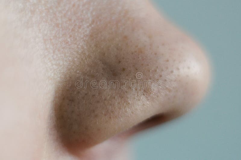 Black Dots on the Nose. Close Up Stock Photo - Image of face, clogged:  164944996