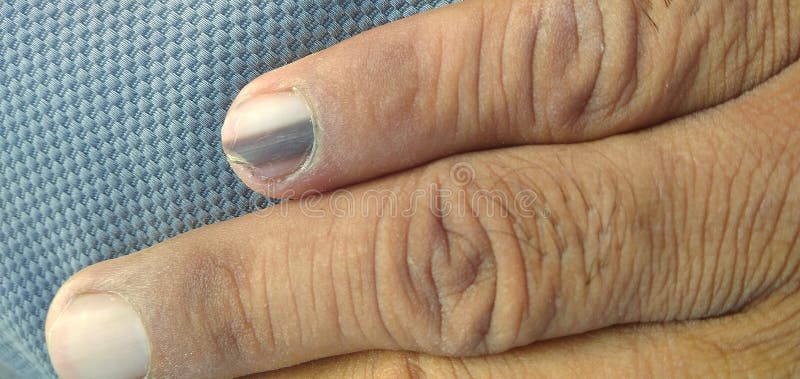 17 Splinter Hemorrhage Nails Images, Stock Photos, 3D objects, & Vectors |  Shutterstock